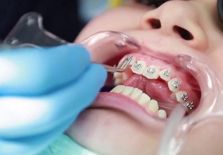 Sau khi niềng răng xong có bị hở lợi không?