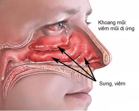 Viêm mũi dị ứng khi mang thai có sao không?