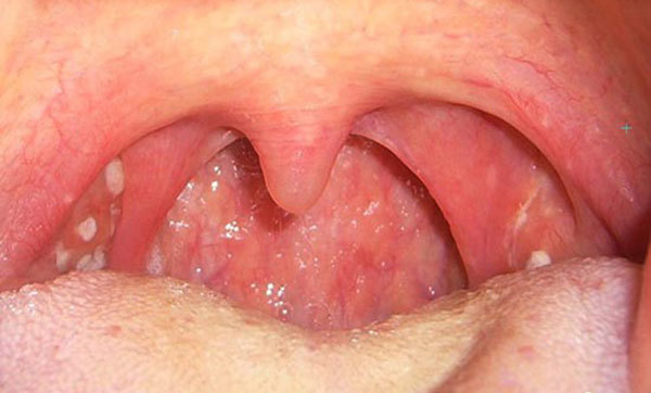 Ung thư vòm họng có triệu chứng như thế nào?