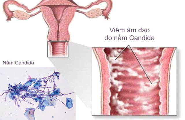 Viêm âm đạo dai dẳng mãn tính 