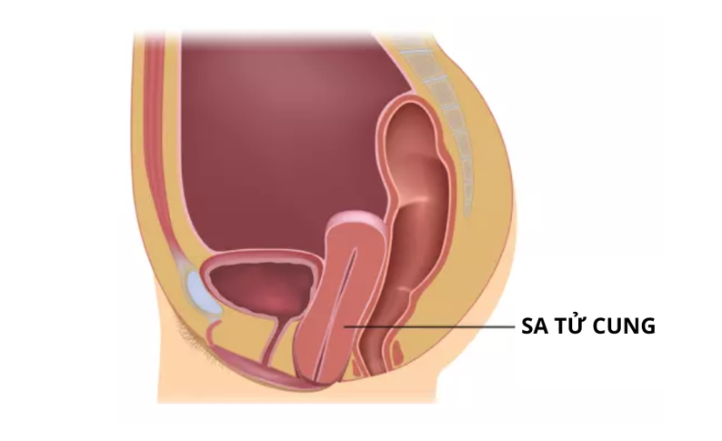 Bạn bị sa tử cung ở cấp độ nào?