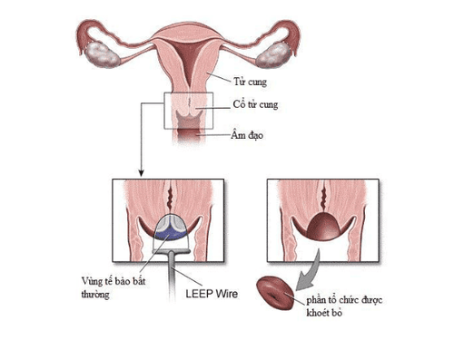 Khoét chóp cổ tử cung là gì?