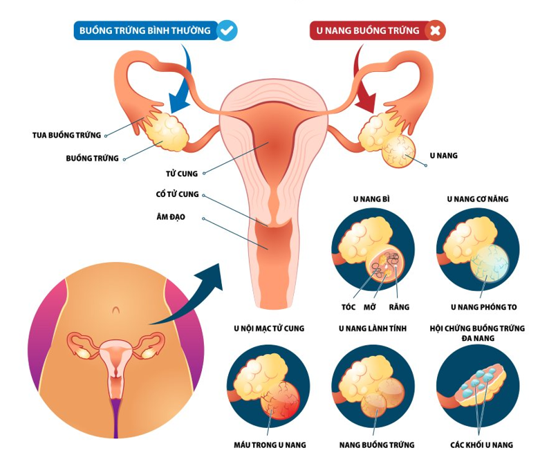 Nang Buồng Trứng Xuất Huyết Trong Thai Kỳ – Nguy Cơ Và Giải Pháp
