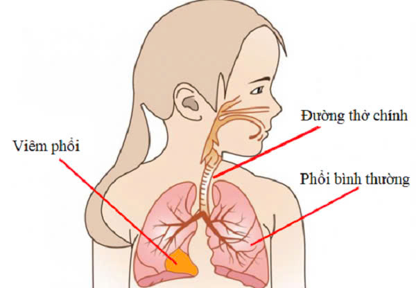 Viêm phổi ở trẻ