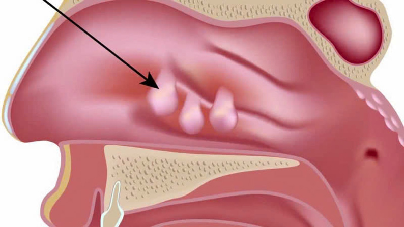 Cắt Polyp bao lâu thì có thể có thai lại?