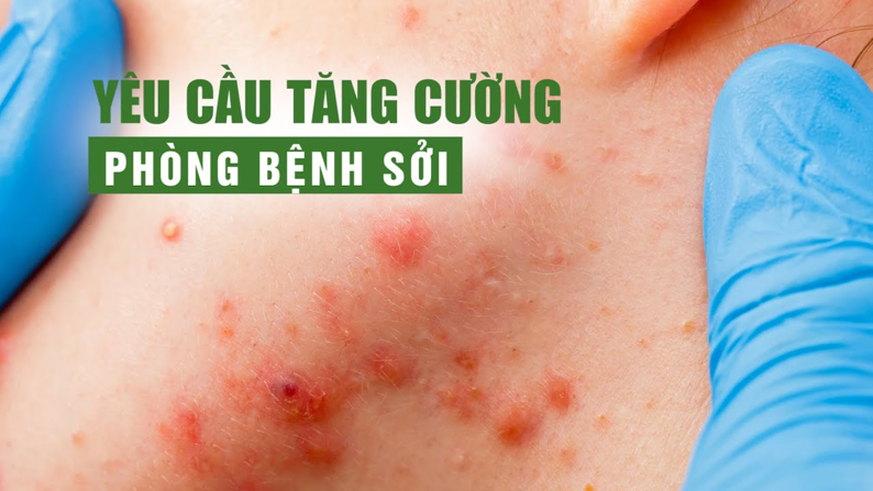 Bệnh sởi: Cách phòng ngừa và bảo vệ trẻ không bị tấn công