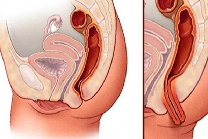 Sinh mổ có bị sa tử cung sau sinh không?