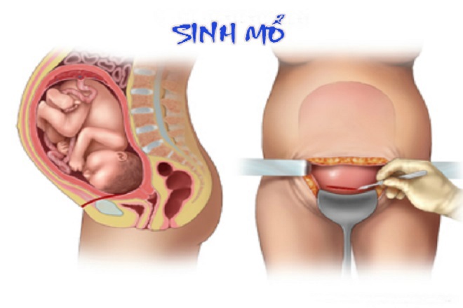 Thai kỳ có vết mổ cũ