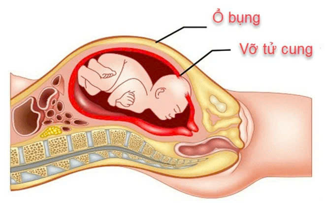 Thai kỳ có vết mổ cũ