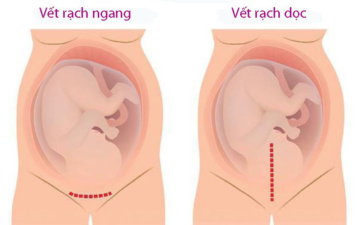 Thai kỳ có vết mổ cũ