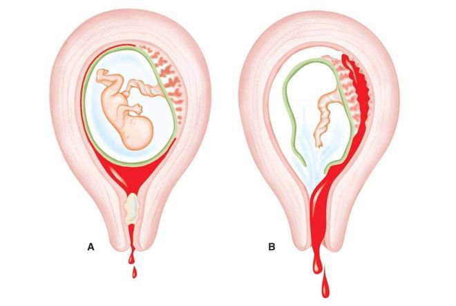 Nhau thai bám thấp có sao không?