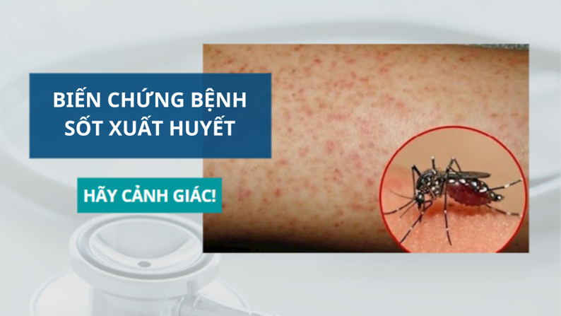 Những Biến Chứng Nguy Hiểm Của Sốt Xuất Huyết Bạn Cần Biết