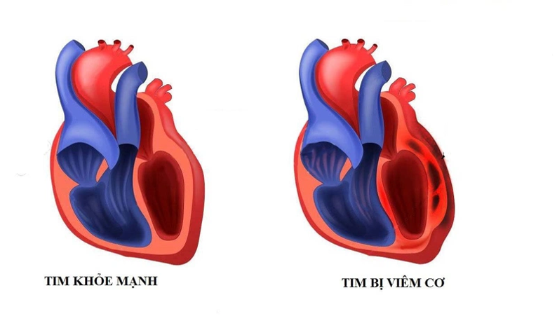 Những Biến Chứng Nguy Hiểm Của Sốt Xuất Huyết Bạn Cần Biết