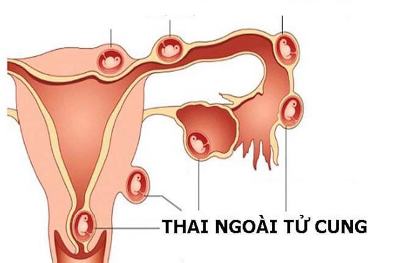 Yếu tố nào tăng nguy cơ thai ngoài tử cung?