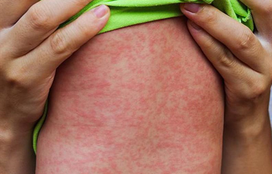Bệnh sởi ở trẻ: Nguyên nhân, triệu chứng và cách điều trị
