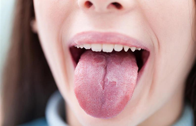 Nguyên nhân nổi mụn ở cuống lưỡi: Tìm hiểu về nguyên nhân và cách khắc phục