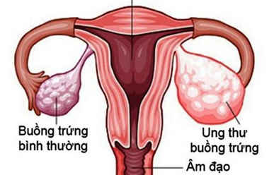 Vì sao ung thư buồng trứng ít được phát hiện sớm?
