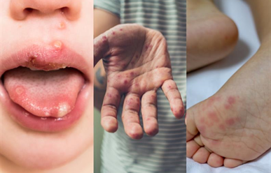 Tay chân miệng dấu hiệu và cách điều trị?