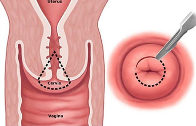 Trường hợp nào được chỉ định làm khoét chóp cổ tử cung?