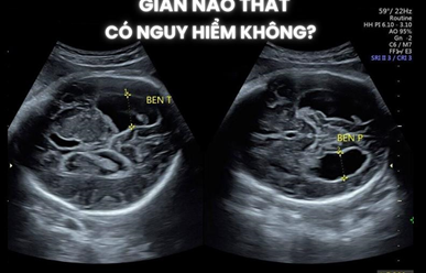 Giãn Não Thất Ở Thai Nhi: Nguyên Nhân, Chẩn Đoán Và Hướng Xử Trí