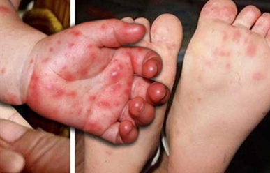 Các xét nghiệm giúp phát hiện sớm bệnh tay chân miệng