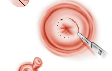 Khoét chóp cổ tử cung có ảnh hưởng đến khả năng sinh sản?