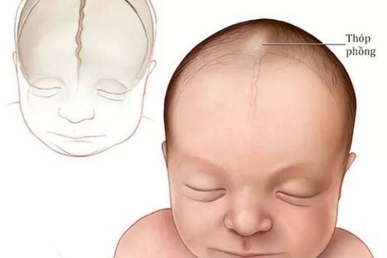 Làm sao để biết thóp bé sơ sinh đóng hay chưa?