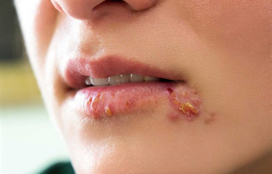 Bệnh giời leo nguyên nhân và cách điều trị