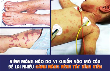 Cảnh Báo: Bệnh Não Mô Cầu Đang Tiềm Ẩn Trong Cộng Đồng