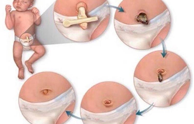 Nhiễm trùng rốn sơ sinh