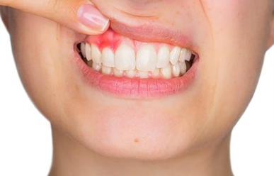 Bệnh viêm nha chu có chữa khỏi không?