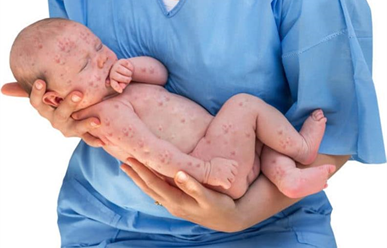 Bị sởi rồi có bị lại nữa không?
