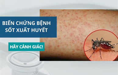 Những Biến Chứng Nguy Hiểm Của Sốt Xuất Huyết Bạn Cần Biết