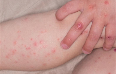 Cách nhận biết bệnh Tay - Chân - Miệng ở trẻ
